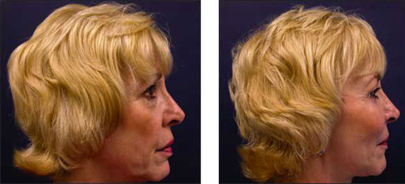 facelift surgeon cosmetic surgery