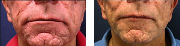 Chicago facelift surgeon cosmetic surgery