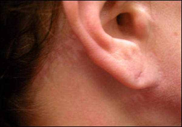 Pixie earlobe deformity repair