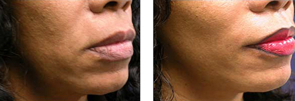 facelift surgeon cosmetic surgery