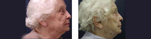 lower facelift and necklift